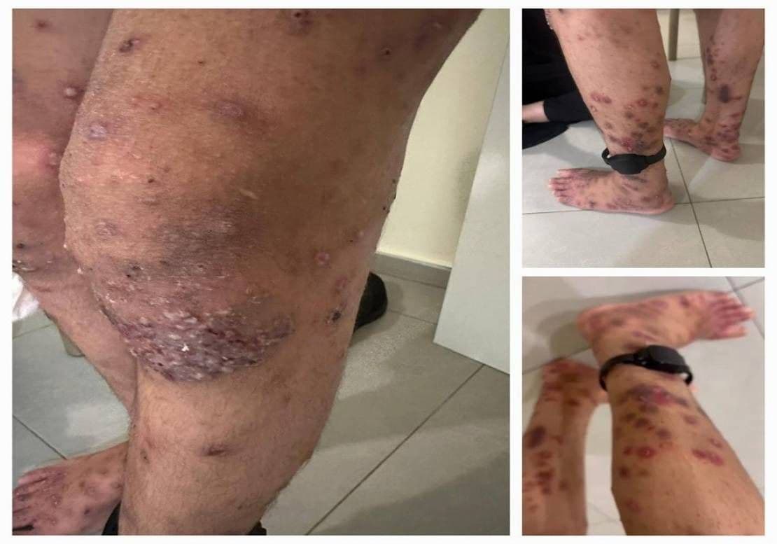 Scabies Outbreak at Nujeen Prison