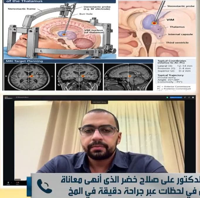 تفاصيل عملية لعلاج شلل رعاش