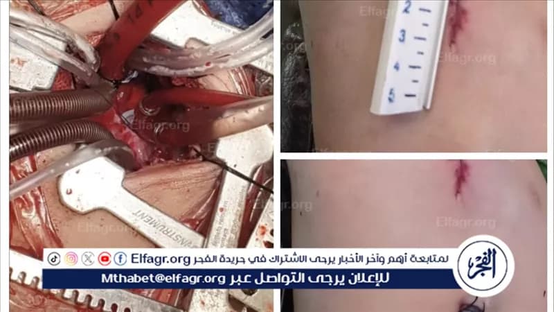فريق أسيوط يعالج عيب خلقي بقلب طفل