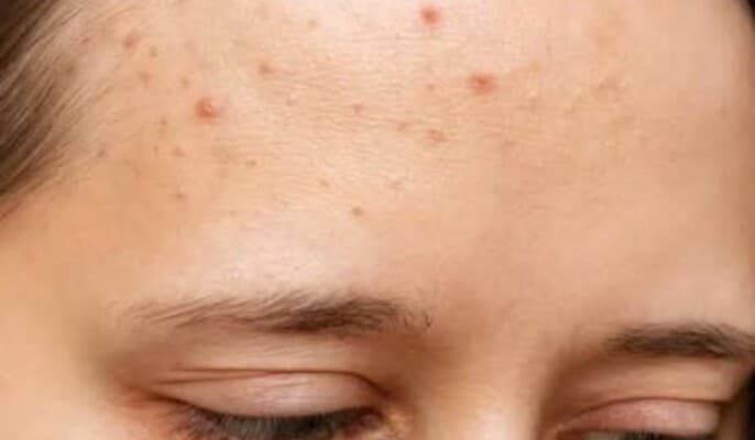Forehead pimples linked to hair products