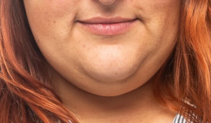Are double chin exercises beneficial