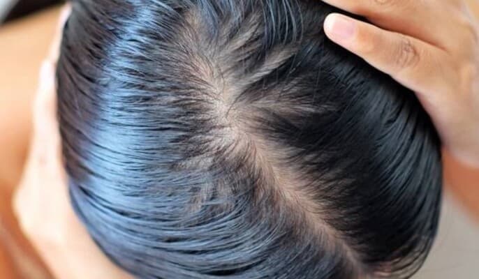 أسباب زيادة دهنية الشعر أحيانا