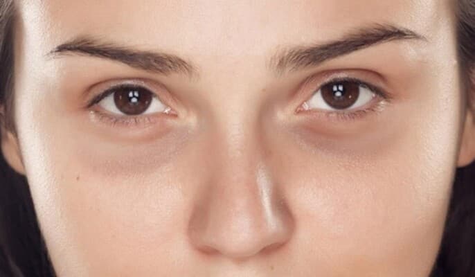 Factors Affecting Dark Circles' Darkness
