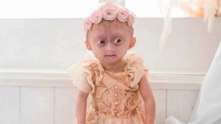 Farewell to girl with early aging