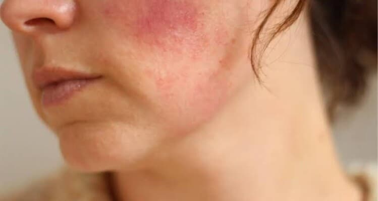 7 ingredients to reduce facial pigmentation