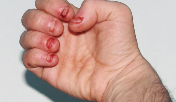 Nail-biting harms oral health