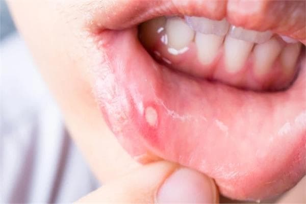 طرق طبيعية لتخفيف ألم قرح الفم