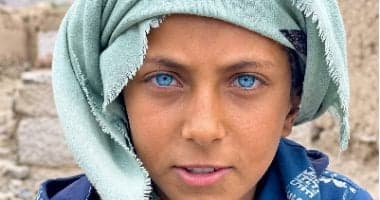 تحول حياة طفل يمني بعد إصابته بعينين زرقاوين