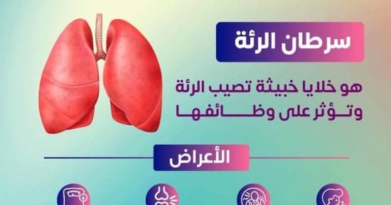 وزارة الصحة تحذر من 4 علامات تشير إلى سرطان الرئة
