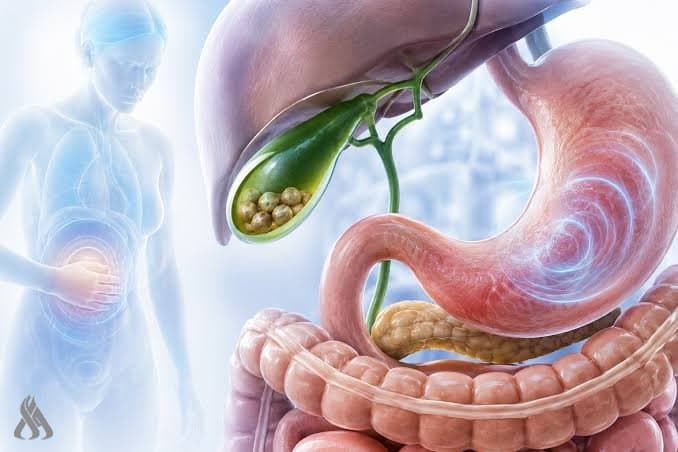 Doctor outlines gallstone symptoms and risks