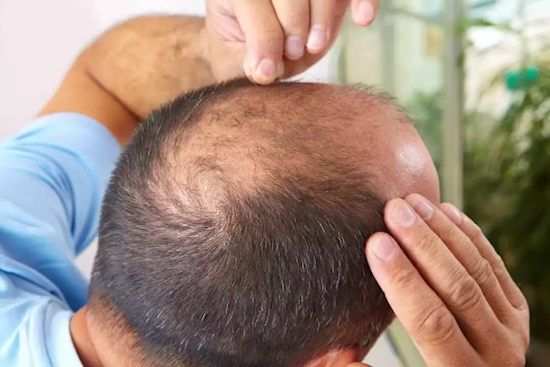 تحذير من أدوية جلدية مقلدة لعلاج الصلع