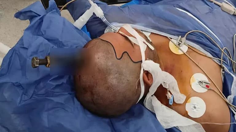 قصر العيني يعالج مريضًا من مسمار في الجمجمة