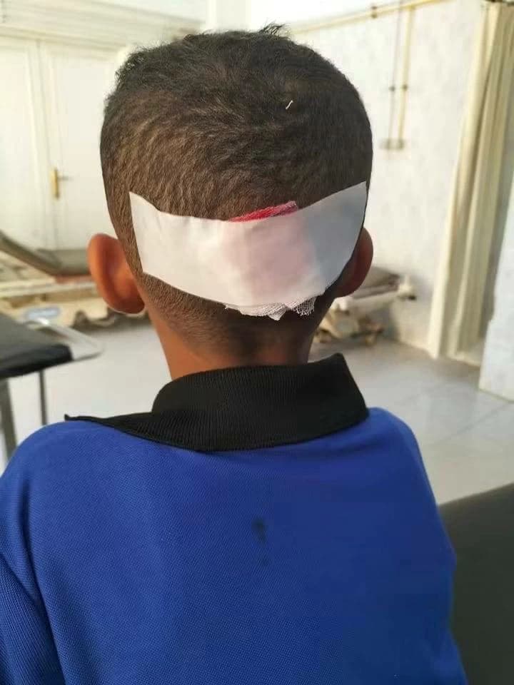 طفل يُصاب برأسه بعد اعتداء زميله في مدرسة والوادي الجديد