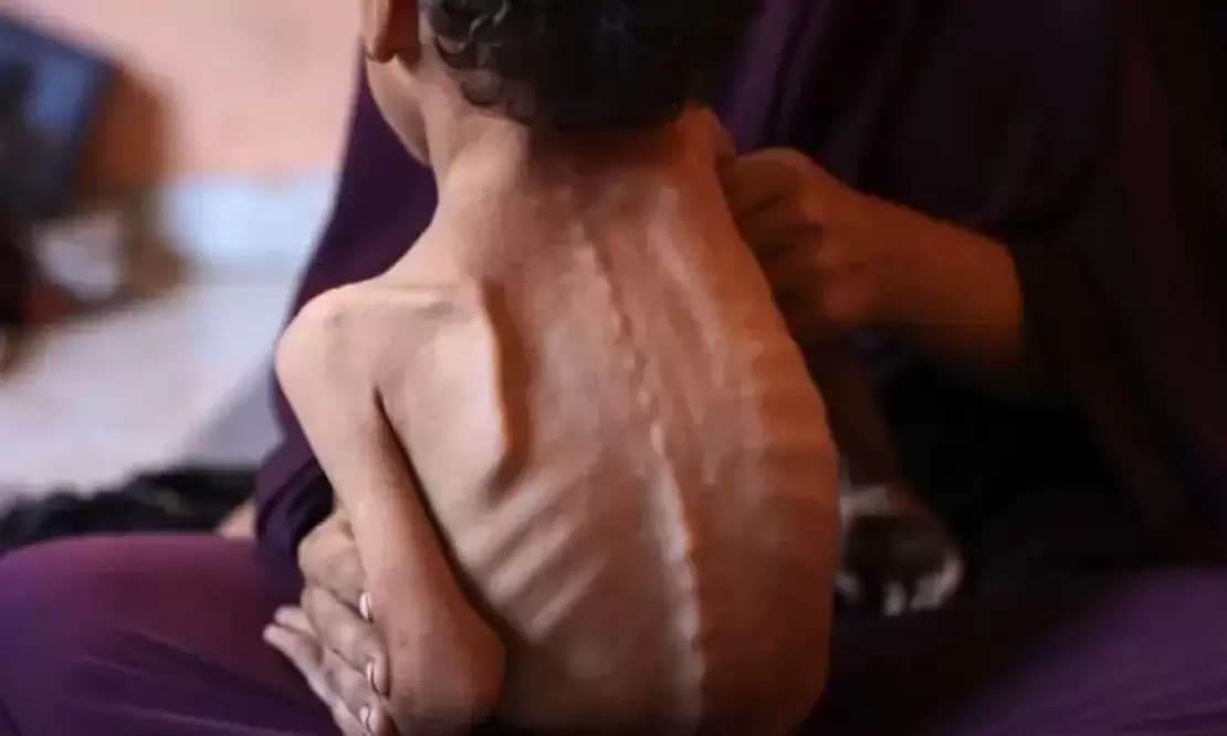 Starvation Persists in Gaza Despite Ceasefire