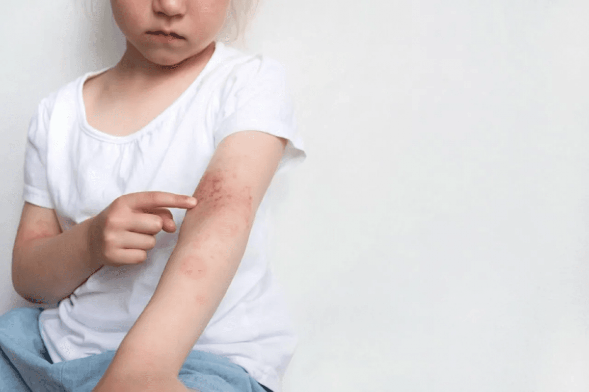 Link Between Frequent Colds and Child Eczema