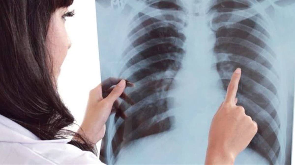 الصحة تعلن مدة نتائج فحص سرطان الرئة