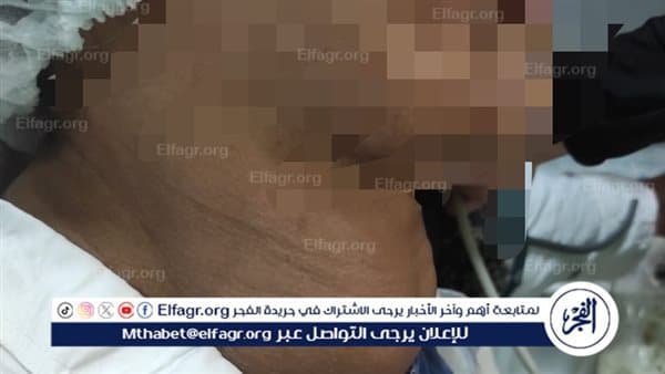 إزالة ورم كبير في الغدة الدرقية مع الحفاظ على عصب الصوت