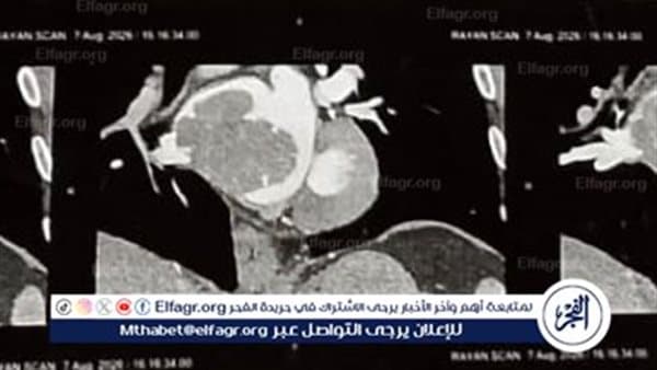 فريق طبي بجامعة أسيوط ي excision ورم نادر بقلب مريض من المنيا