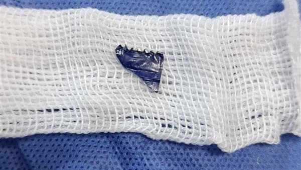 طفل عمره 8 أشهر يواجه خطرًا بسبب كيس مايونيز عالق بين الحبال الصوتية