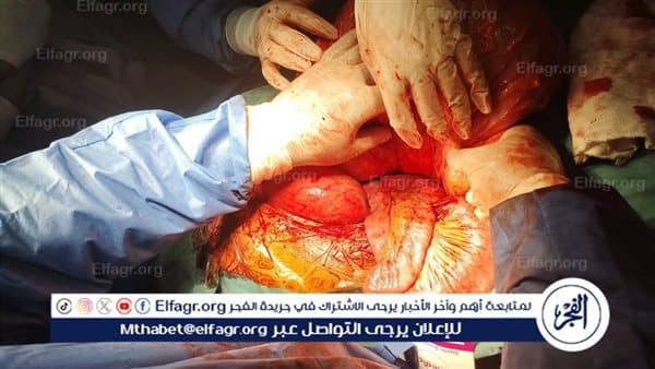 فريق جامعة أسيوط يعالج ارتخاء الحجـــــاب