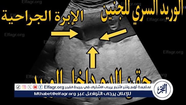 علاج دموي ينقذ جنينا في أسيوط