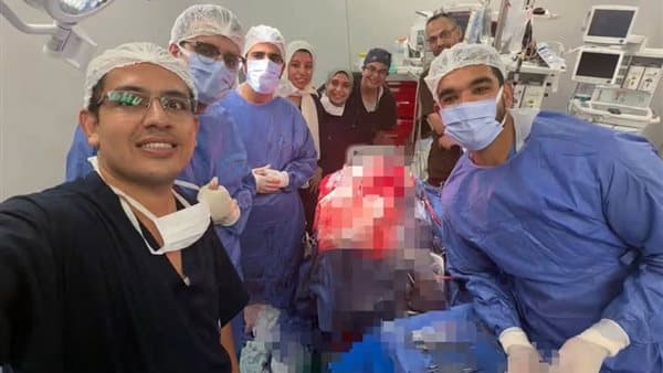 فريق طبي بقصر العيني ينجح في إزالة مسمار من جمجمة مريض