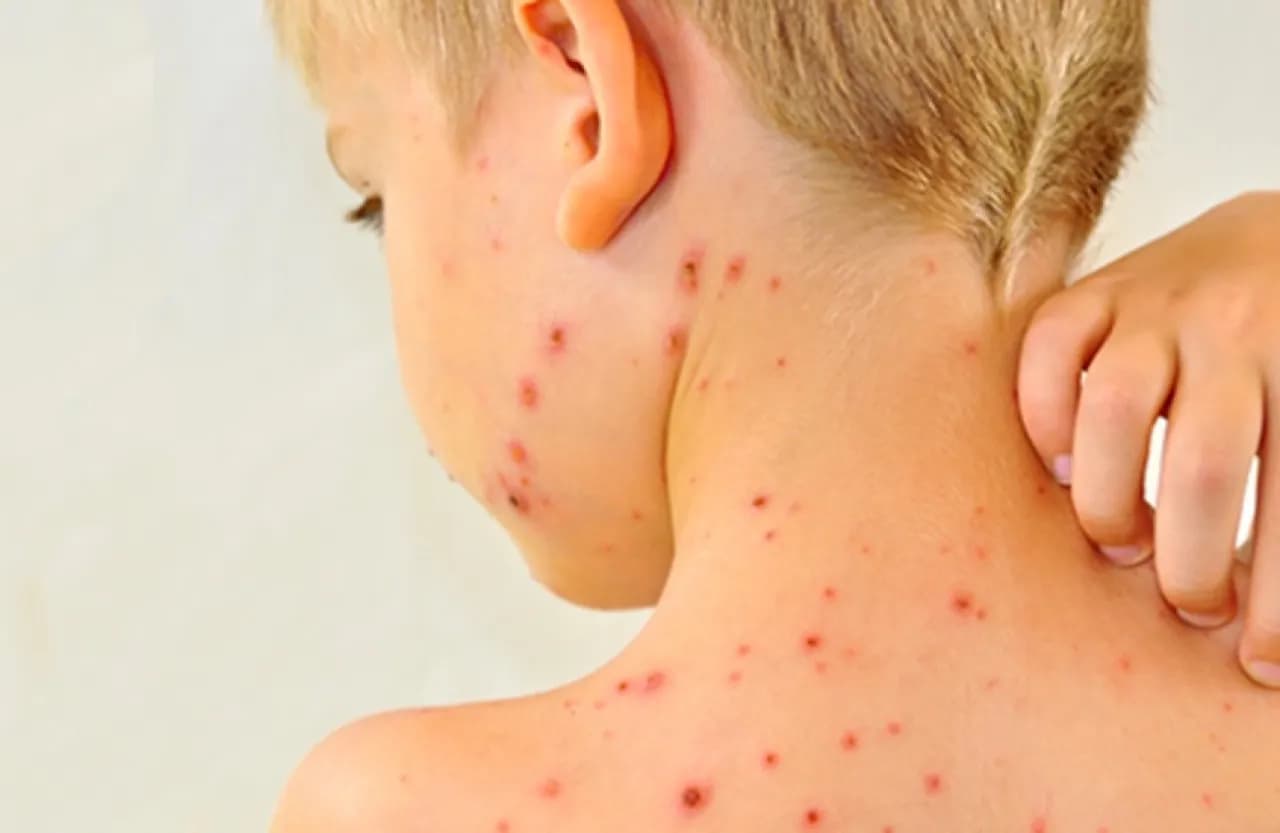 Measles Outbreak Causes 4 Deaths and Injuries