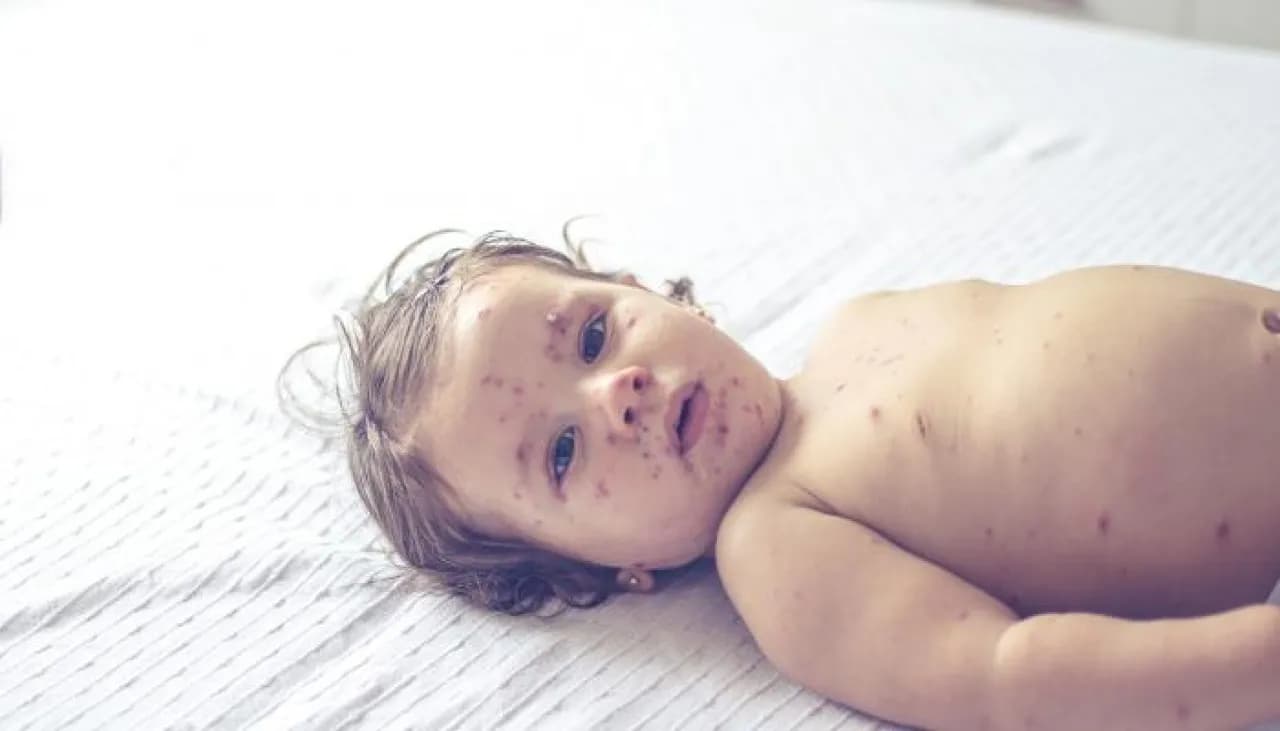 US Measles Cases Surpass 4400
