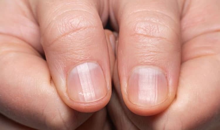 Nail Signs of Health Concerns