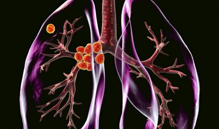 New discovery advances pulmonary fibrosis treatment