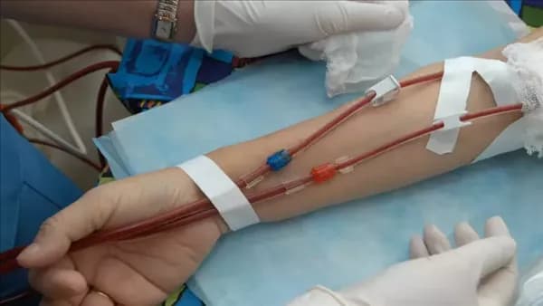 الصحة تنبه مرضى الغسيل الكلوي للأعراض المهمة
