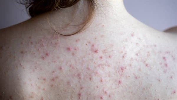 اصنعي صابونة طبيعية لحبوب الظهر