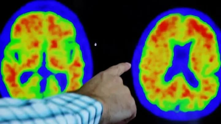 Researchers suggest Alzheimer's damage may be reversible